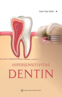 Image of Hipersensitivitas Dentin